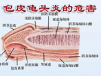 龟头炎