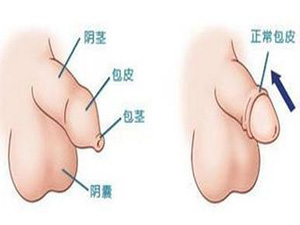 沈阳割包皮手术哪个医院好